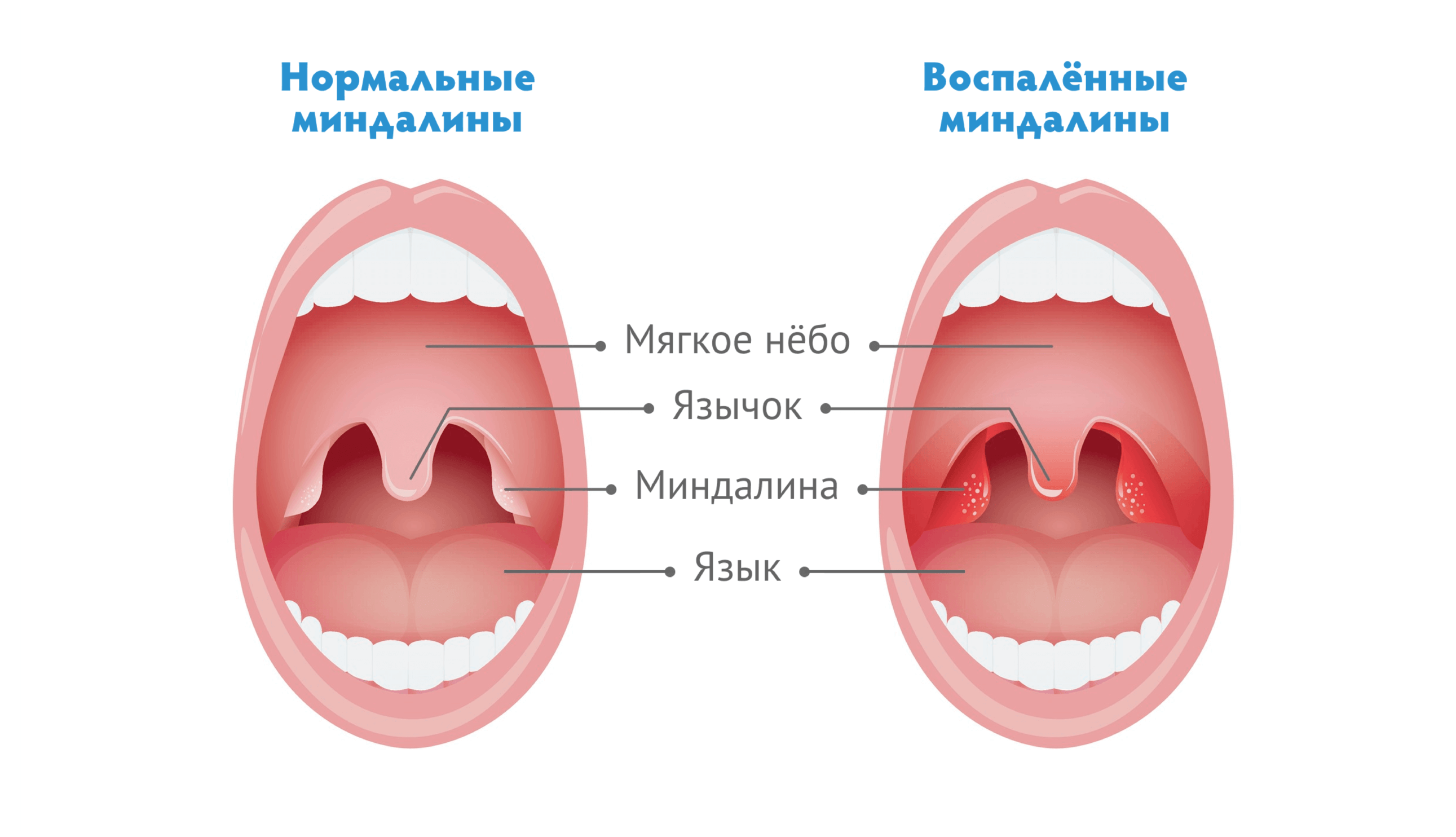 Катаральная ангина фото горла Чем лечить ангину, температура и боль в горле: причины, лечение при боли в горле