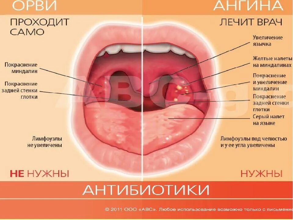 Катаральная ангина фото горла Фолликулярная ангина у детей в 1, 2, 3 года: особенности, симптомы, лечение, пре