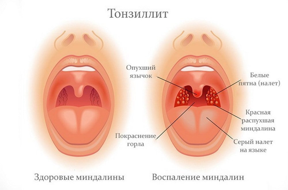 Катаральная ангина фото горла Хронический тонзиллит: возможно ли добиться ремиссии? Медицинский центр Е.В. Мал