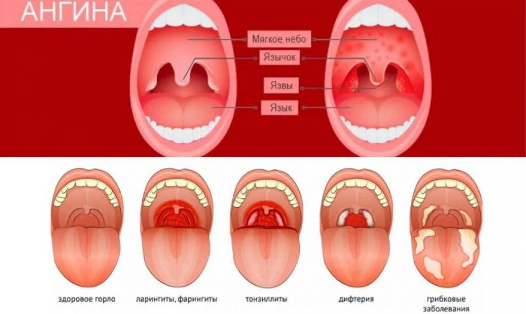 Катаральная ангина фото горла Герпетическая ангина у беременных - почему возникает и что с этим делать? О детс