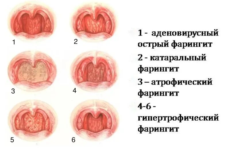 Катаральная ангина фото горла Фарингит - симптомы и лечение в СПб