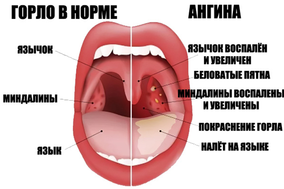 Катаральная ангина фото горла Летняя ангина у ребенка - в чем причины воспаления и несколько опасна болезнь О 