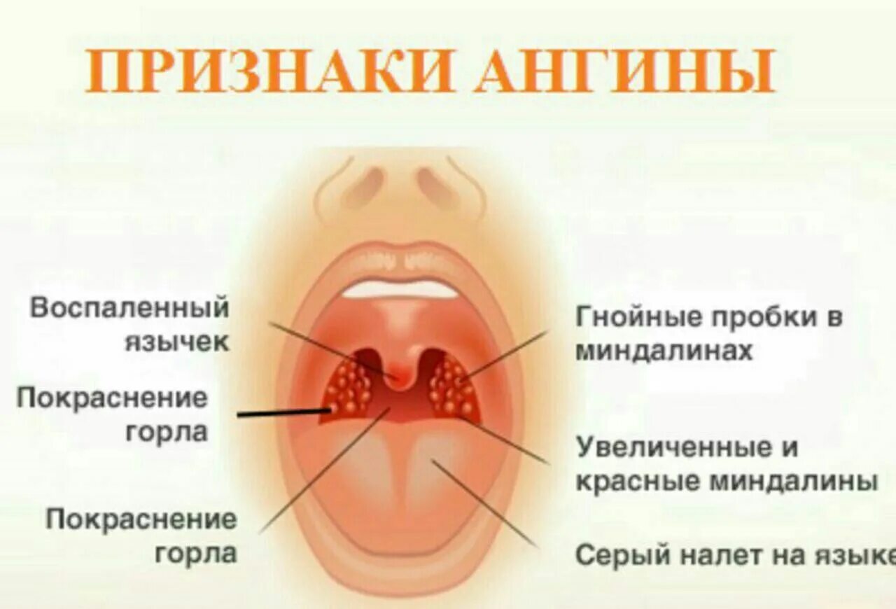 Катаральная ангина фото горла Картинки СКОЛЬКО ДНЕЙ ТЕМПЕРАТУРА ПРИ ТОНЗИЛЛИТЕ