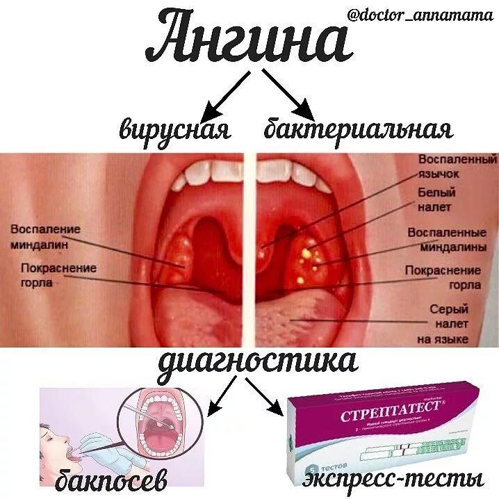 Катаральная ангина фото горла Это страшное слово "ангина" - Статьи - Клиника "C Нуля" (Здоровая семья)