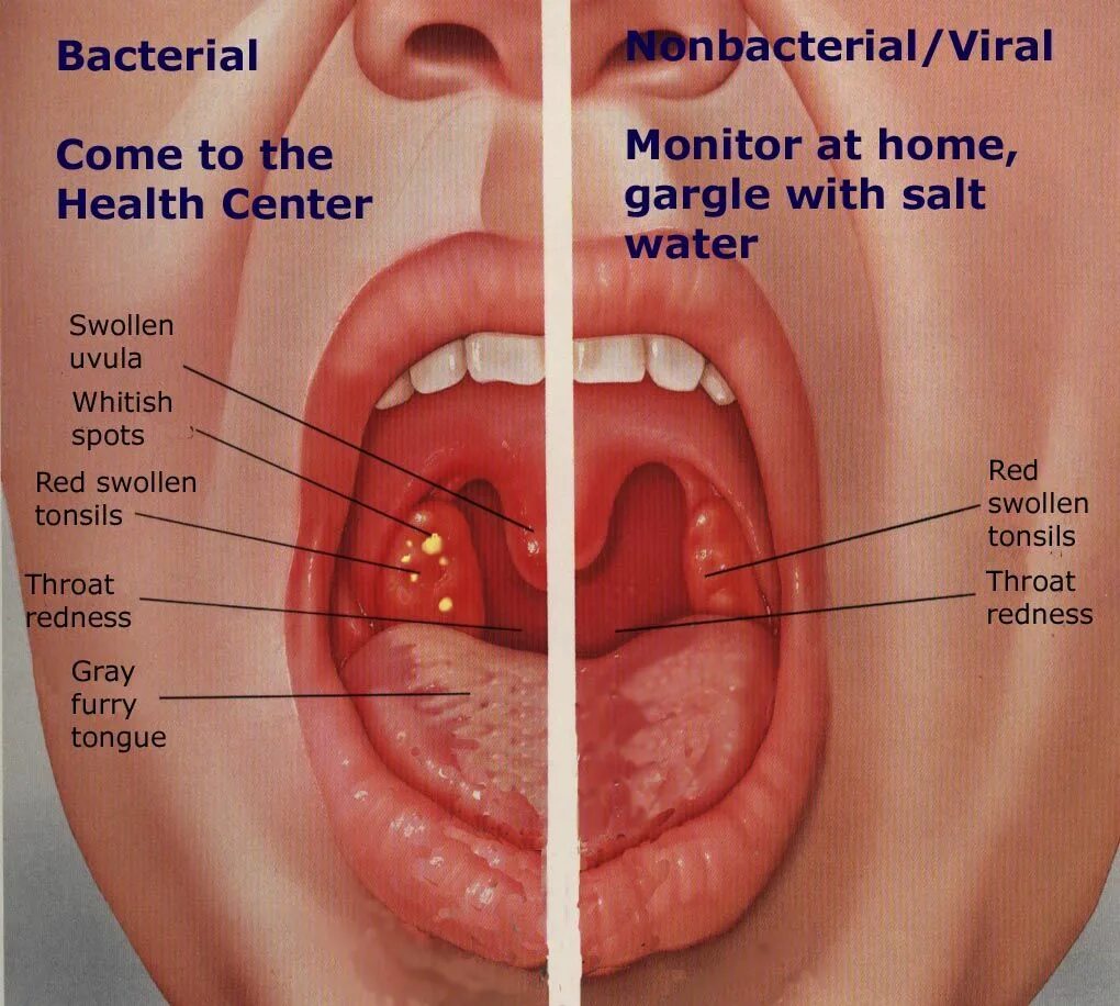 Катаральная ангина фото горла What do you think? Treatment for sore throat, Nursing tips, Health