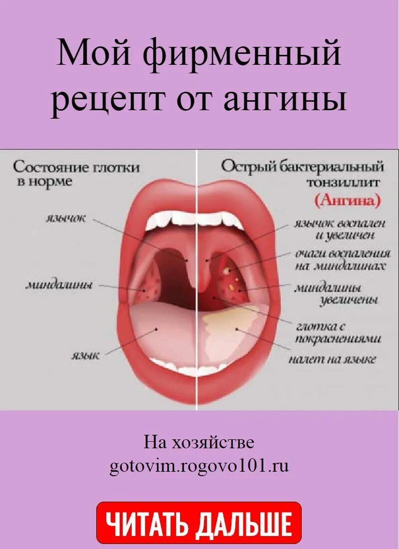 Катаральная ангина фото горла Мой фирменный рецепт от ангины Полезные советы Постила