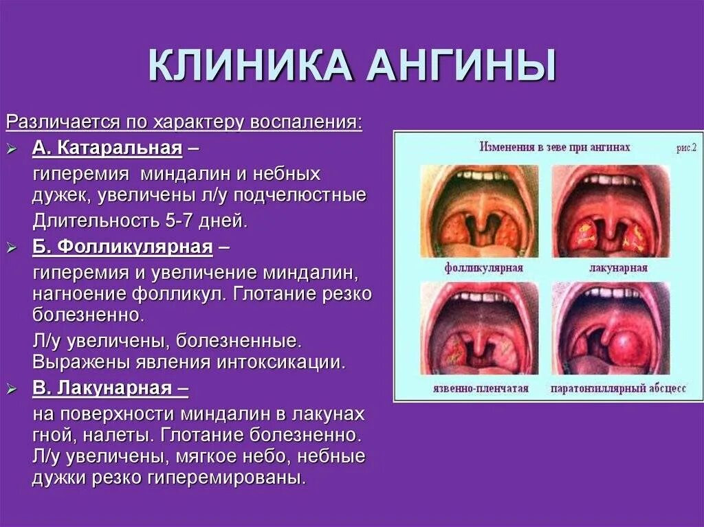 Катаральная ангина фото горла Картинки ХРОНИЧЕСКИЙ ТОНЗИЛЛИТ ЛЕЧЕНИЕ ЛЕКАРСТВА