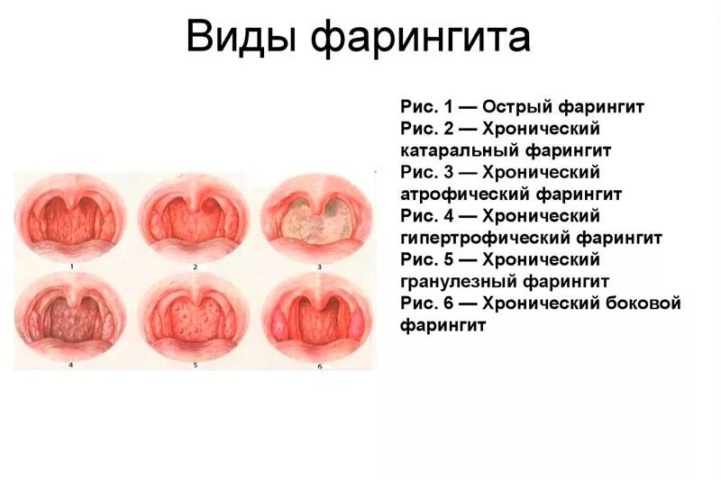 Катаральная ангина фото горла Что такое фарингит. Вирусный и бактериальный фарингит