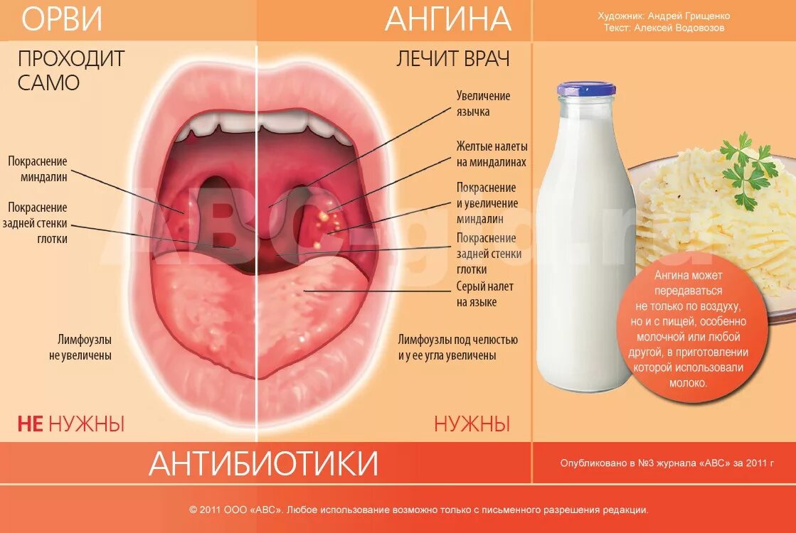 Катаральная ангина фото горла у детей Язык боли текст