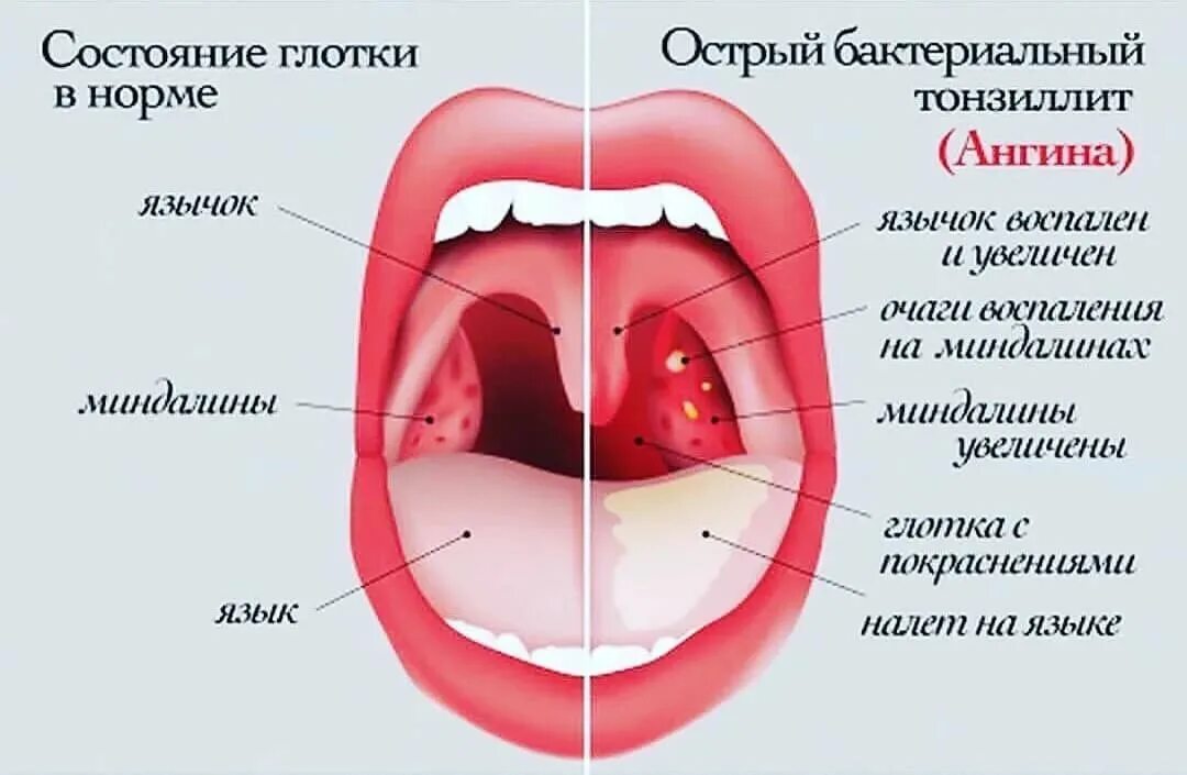 Катаральная ангина фото горла у детей Почему может болеть горло? - Медицинский центр "Добрый Доктор"