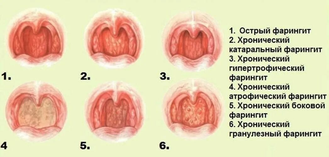 Катаральная ангина фото горла у детей Тест глотки