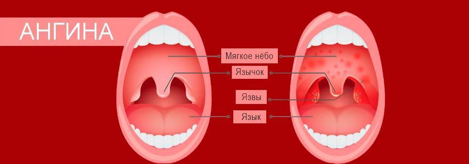 Катаральная ангина фото горло у взрослых Летняя ангина у ребенка - в чем причины воспаления и несколько опасна болезнь О 