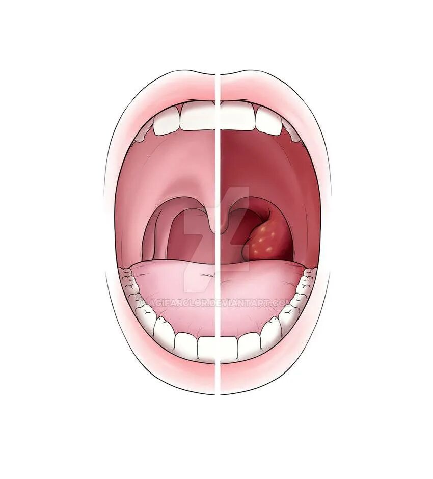 Катаральная ангина фото горло у взрослых Увеличение глоточной миндалины