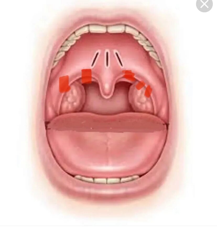 Катаральная ангина фото горло у взрослых На стенках горда сыпь - Вопрос детскому лору - 03 Онлайн