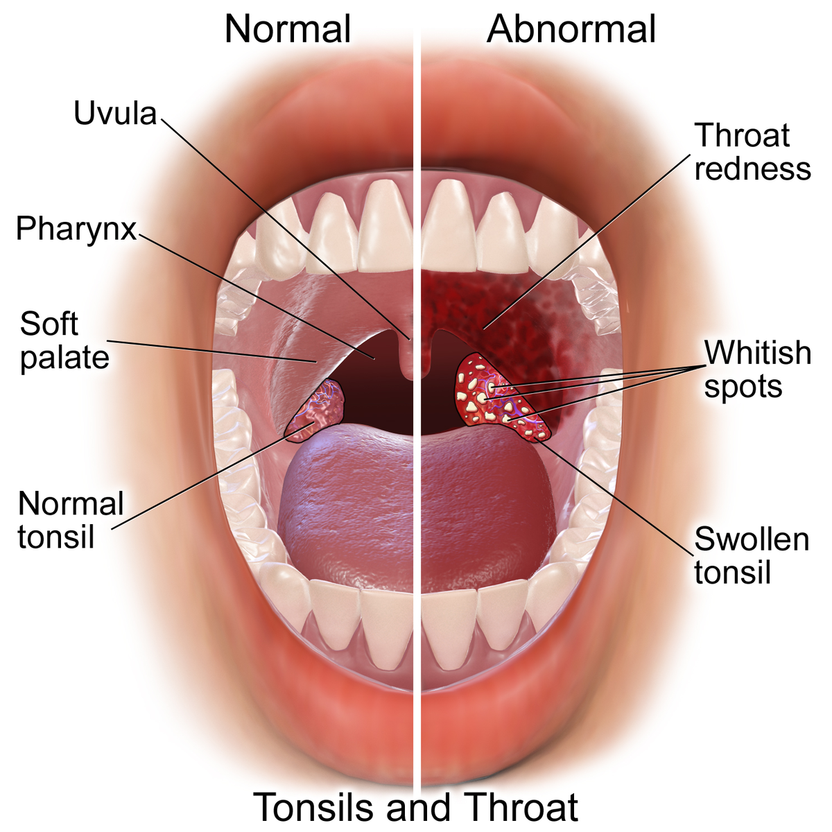 Катаральный фарингит фото горла File:Blausen 0860 Tonsils&Throat Anatomy.png - Wikipedia