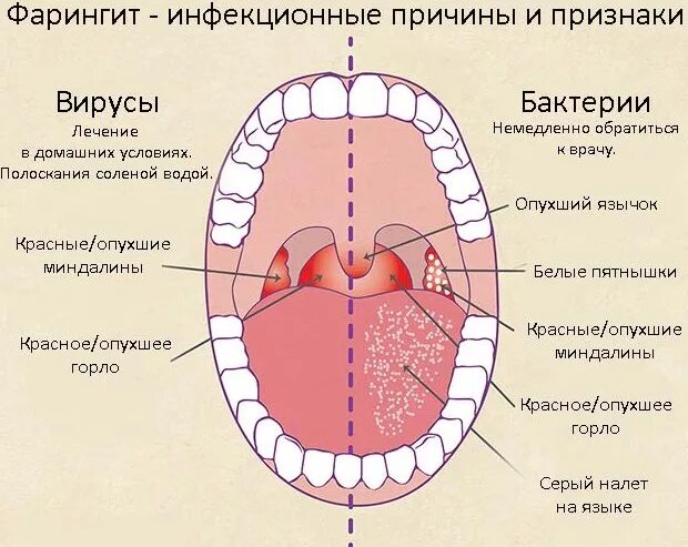 Катаральный фарингит фото горла Фарингит: симптомы, причины возникновения и способы лечения заболевания