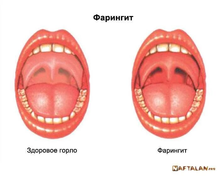 Катаральный фарингит фото горла Симптомы катаральной ангины у детей и методы лечения заболевания горла