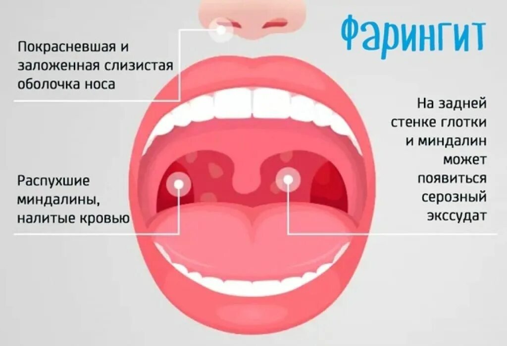 Катаральный фарингит фото горла Фарингит: причины возникновения, описание симптомов, диагностика и лечение - MED