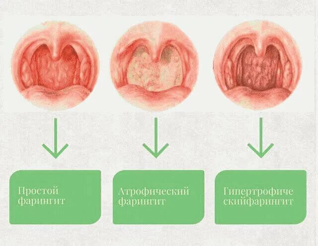 Катаральный фарингит фото горла Фарингит острый и хронический у взрослых - о чем нужно знать Наш дом в Новоросси