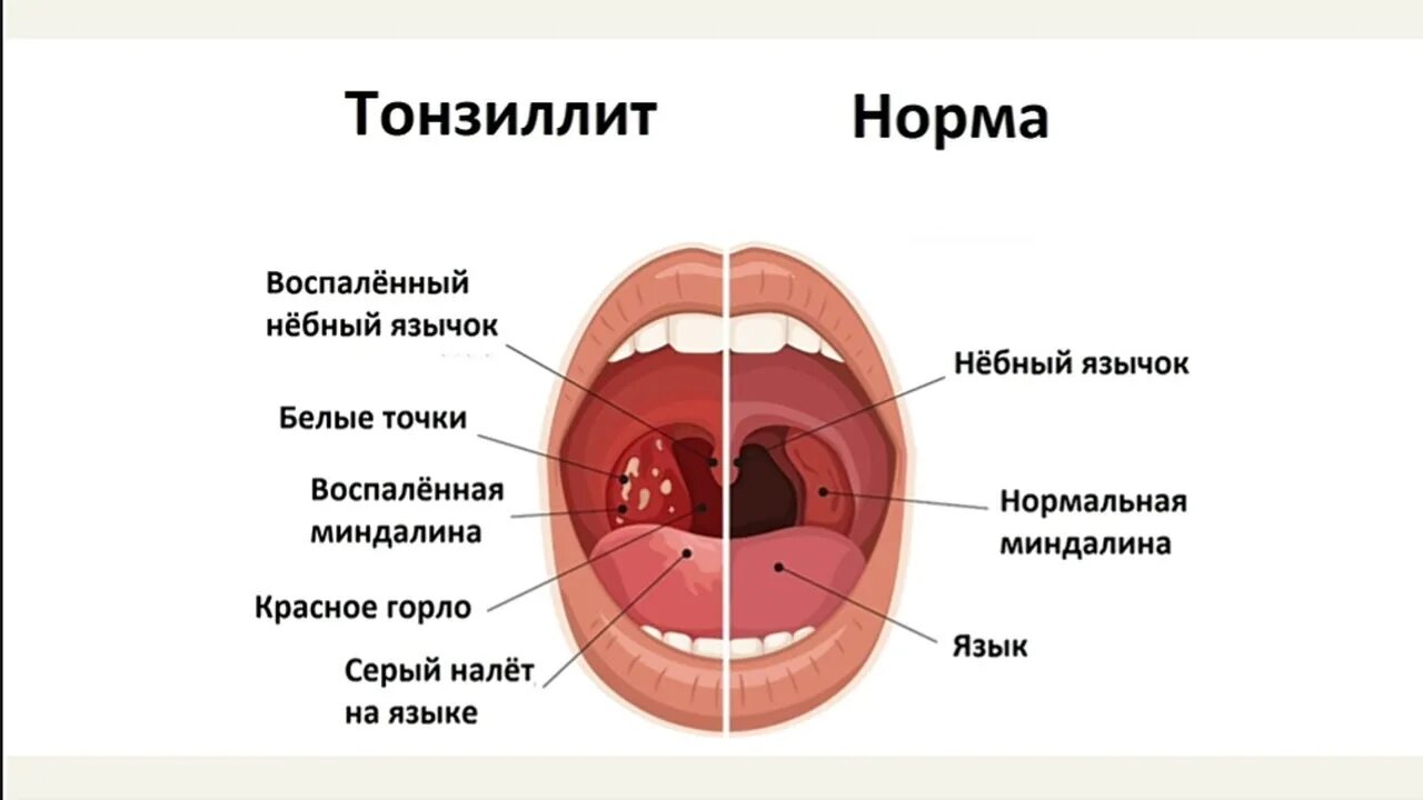 Катаральный фарингит фото горла "Стрептококковая инфекция. Этиология" - YouTube