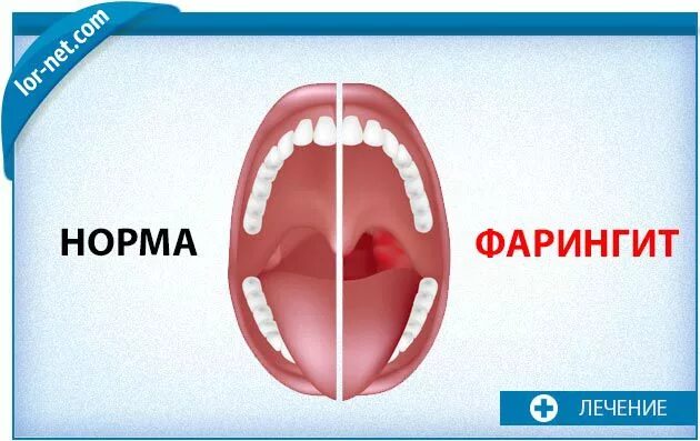 Катаральный фарингит фото горла Лечение фарингита у детей в Красноярске - Лор-нэт
