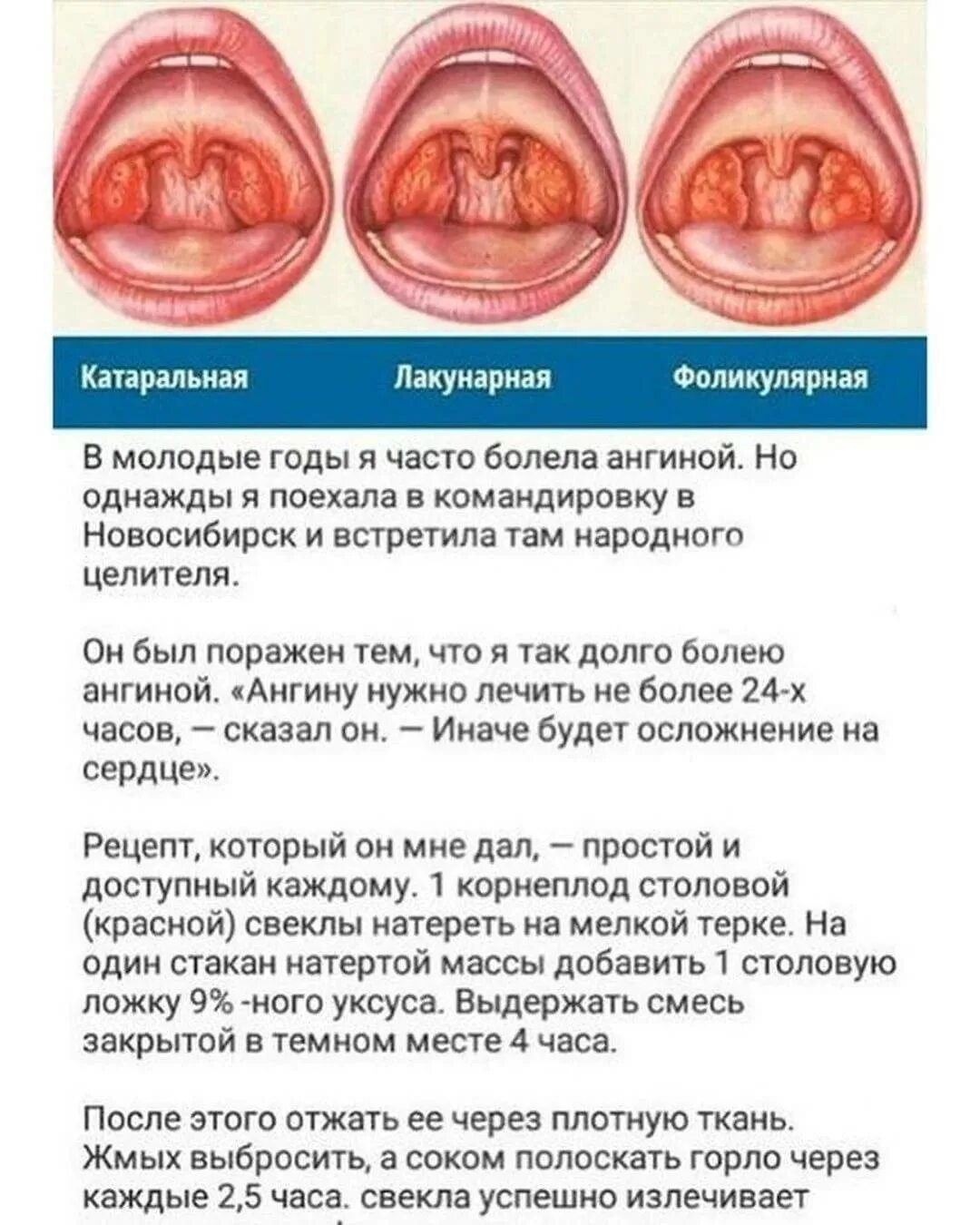 Катаральный фарингит фото горла Чем обусловлено появление сыпи в горле у детей: симптомы, диагностика, что делат