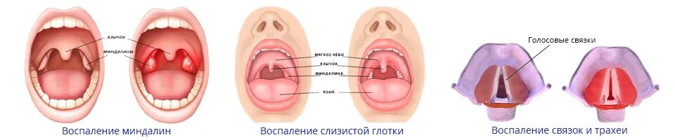 Катаральный фарингит фото горла и гортани Разбираем причины покраснения и першения в горле - Фарингоспрей