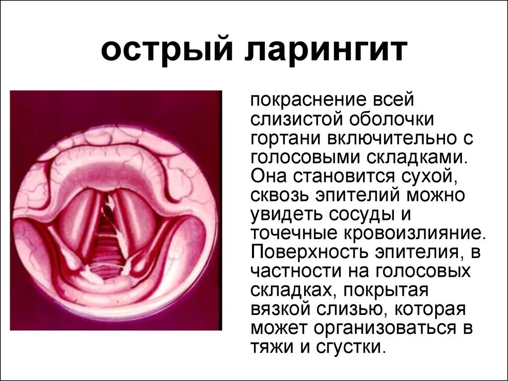 Катаральный фарингит фото горла и гортани Ларингит - это не просто охриплость голоса