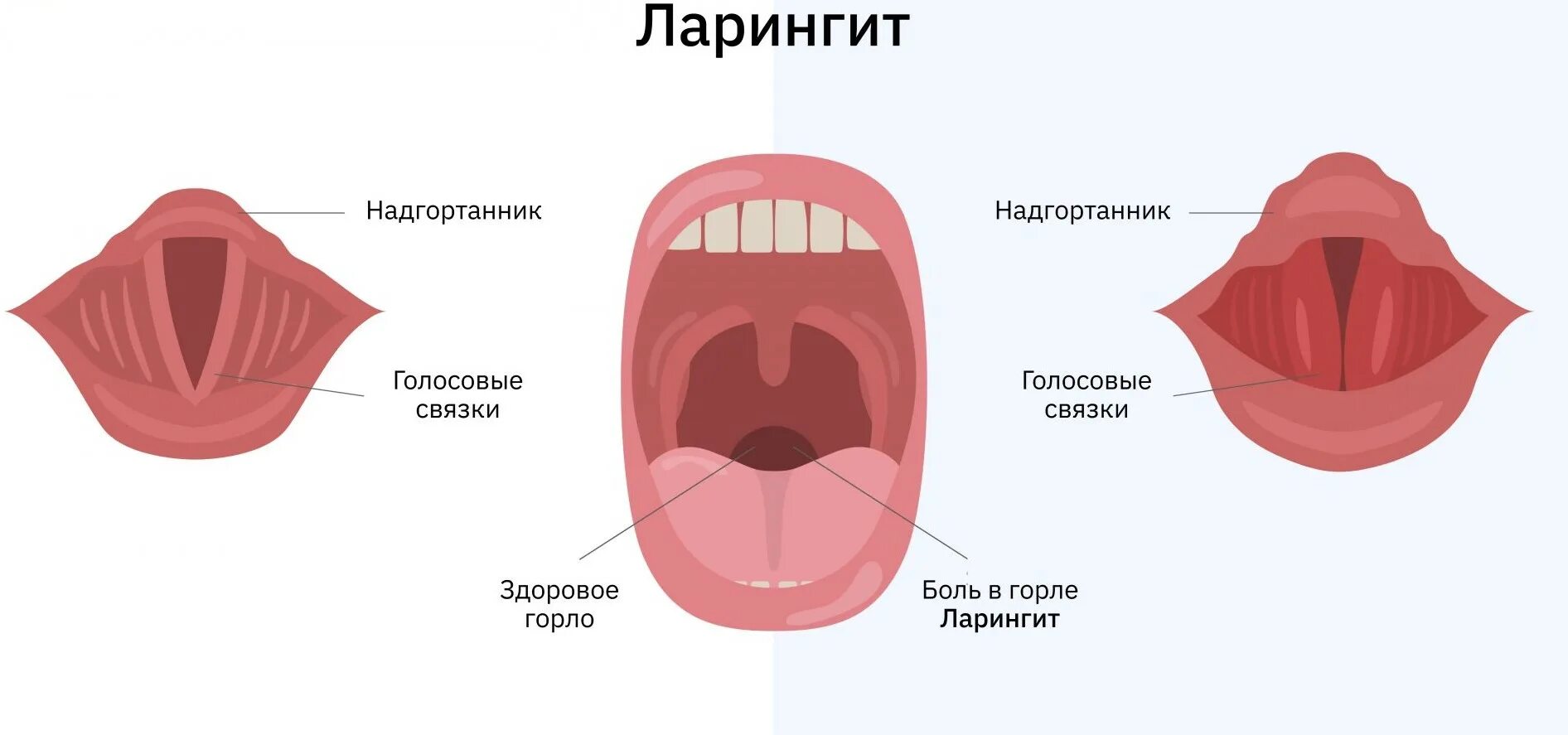 Катаральный фарингит фото горла и гортани Статьи - интерМедикум