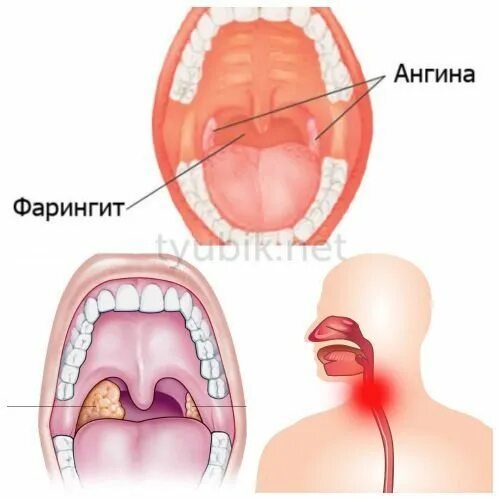 Катаральный фарингит фото горла и гортани Ларингит горла у детей - Арт Минск.ру