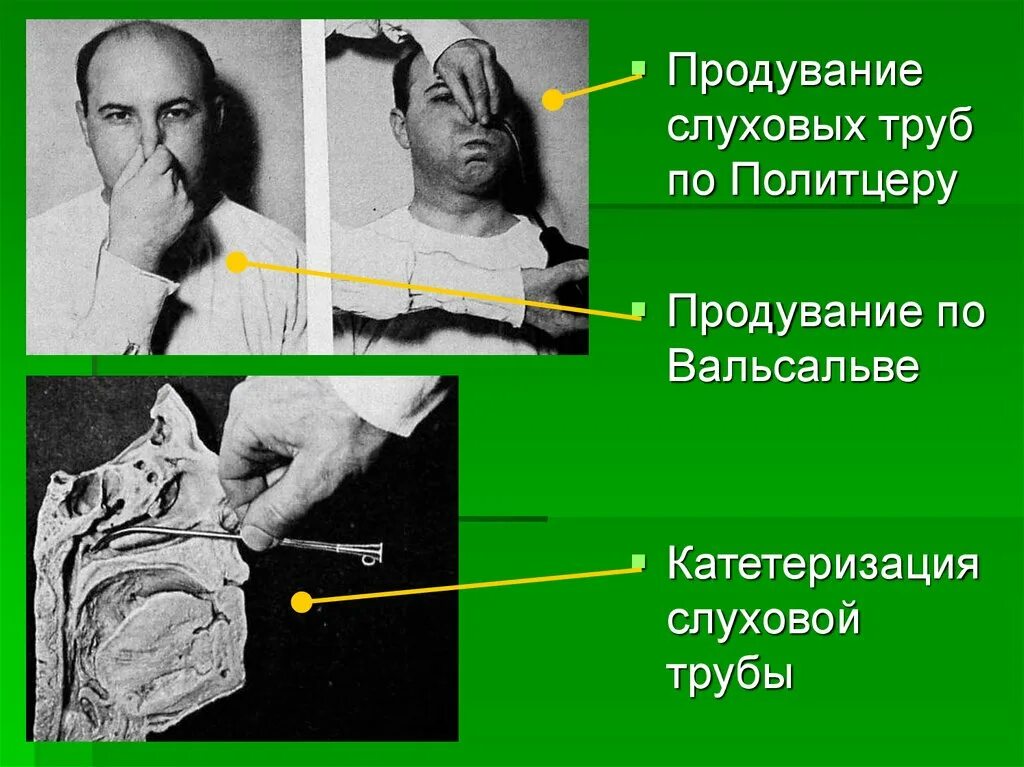 Катетеризация слуховой трубы фото Продувание слуховых труб по политцеру