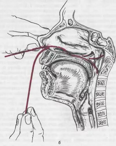 Катетеризация слуховой трубы фото Картинки ПРОДУВАНИЕ ЧЕРЕЗ НОС