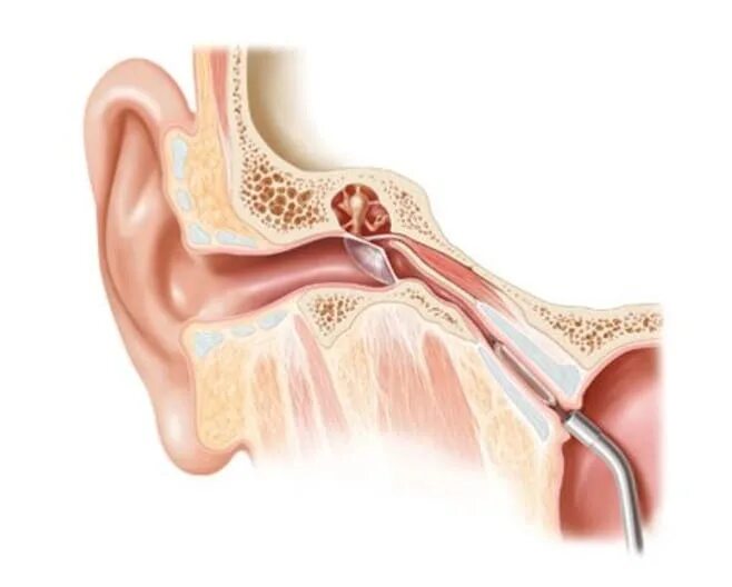 Катетеризация слуховой трубы фото Картинки ТУБООТИТ ЧТО ЭТО ТАКОЕ