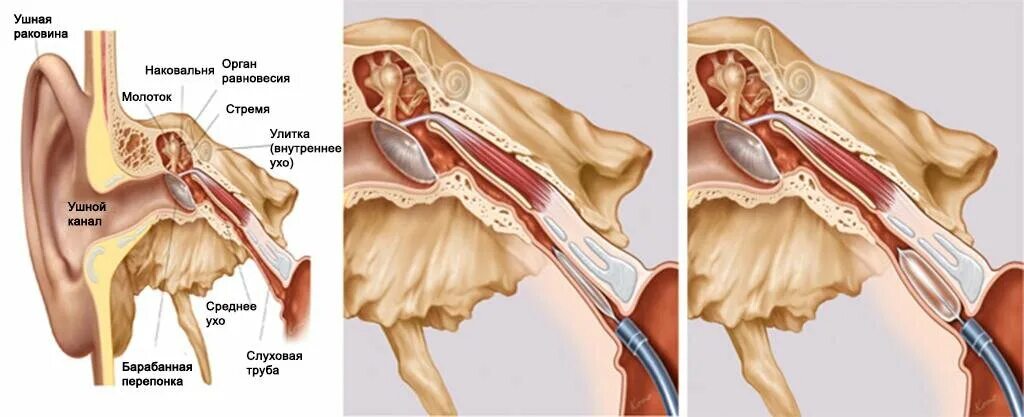 Катетеризация слуховой трубы фото Способ лечения заложенности уха. Баллонная дилатация слуховой трубы. Краткий обз