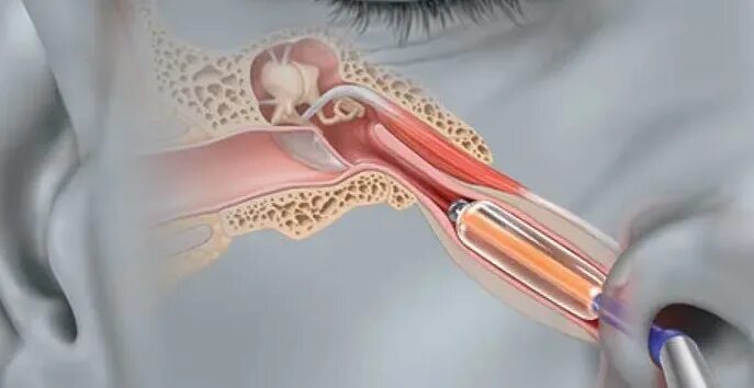 Катетеризация слуховой трубы фото Катетеризация слуховой трубы - цена прохождения в клинике "НаталиМед" в Москве в