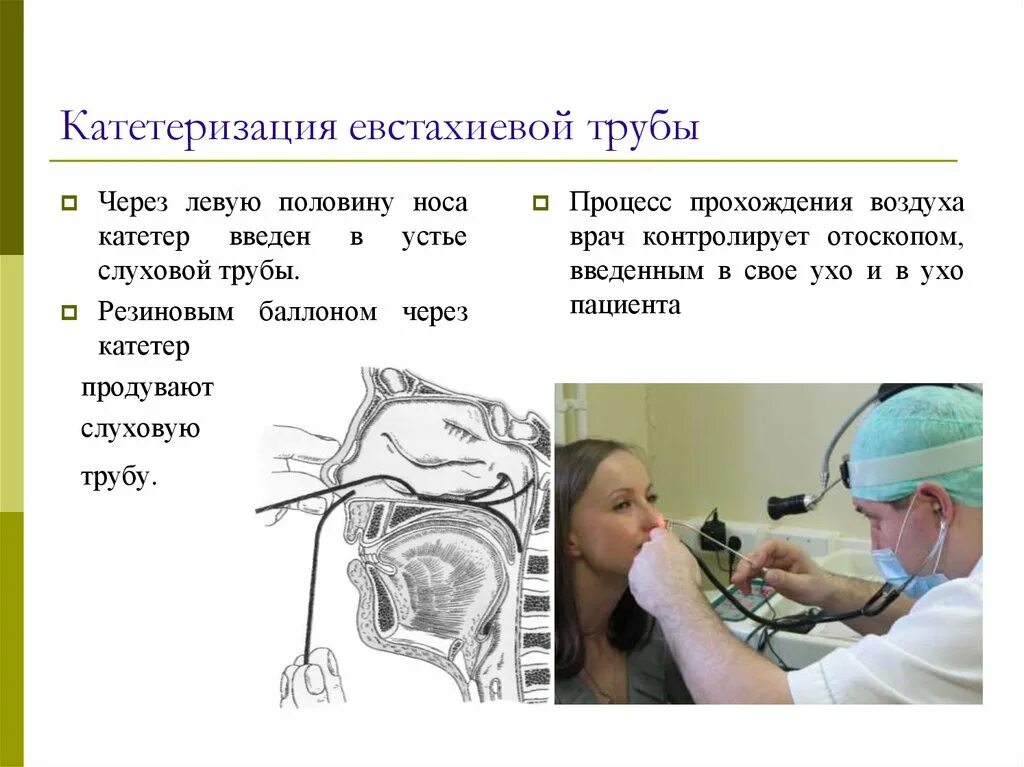 Катетеризация слуховой трубы фото Катетеризация слуховой трубы что это