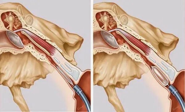 Катетеризация слуховой трубы фото Евстахиит (тубоотит): причины, симптомы и лечение в статье ЛОРа Максимова Е. А.