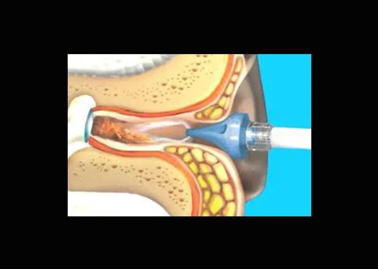 Катетеризация слуховой трубы фото ENT - MedClinic
