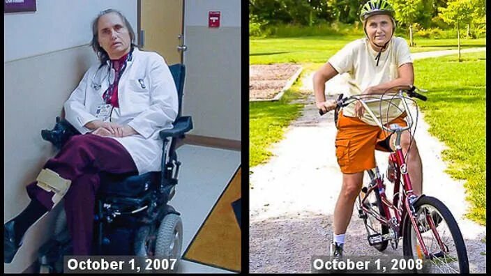 Катя орлова рассеянный склероз до болезни фото US medical academic, Dr Terry Wahls, was diagnosed with MS at age 45. Determined