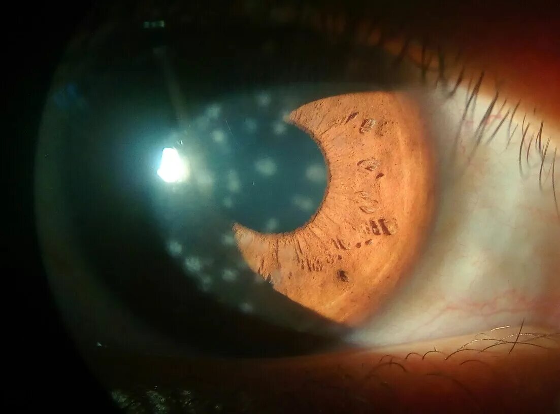 Кератит глаза фото File:Adenoviral keratitis.jpg - Wikipedia