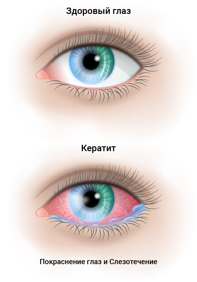 Кератит глаза фото Лечение кератита у взрослых: препараты, капли, уколы Глаукома.ру