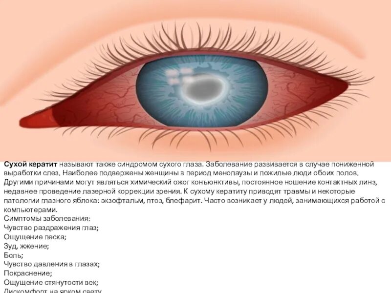 Кератит глаза фото симптомы Признаки конъюнктивита глаз у взрослого