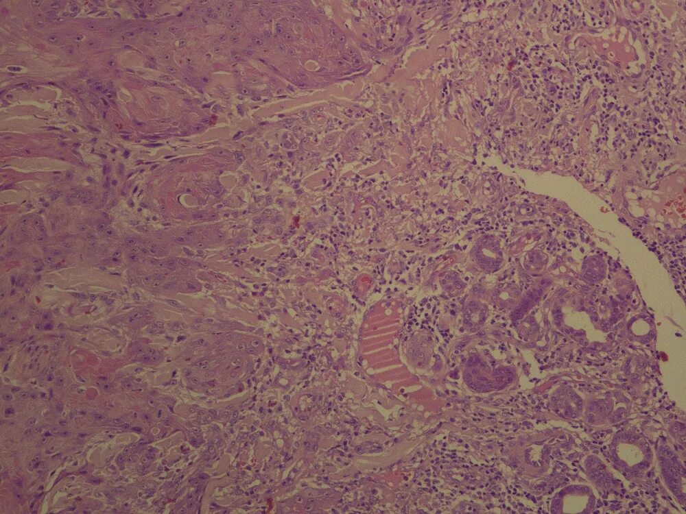 Кератоакантома что это такое фото Keratoacanthoma Like Squamous Cell Carcinoma
