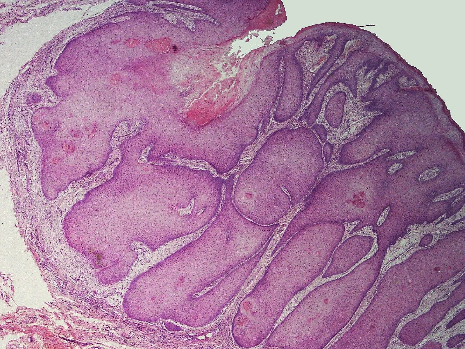 Кератоакантома что это такое фото File:SkinTumors-P8190634.JPG - Wikipedia