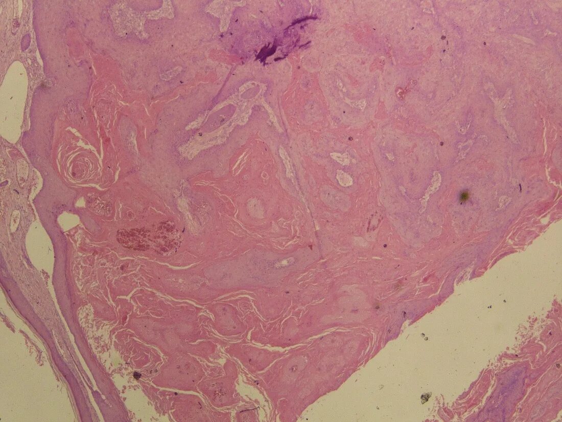 Кератоакантома что это такое фото Squamous Cell Carcinoma Keratoacanthoma Type Pathology Outlines