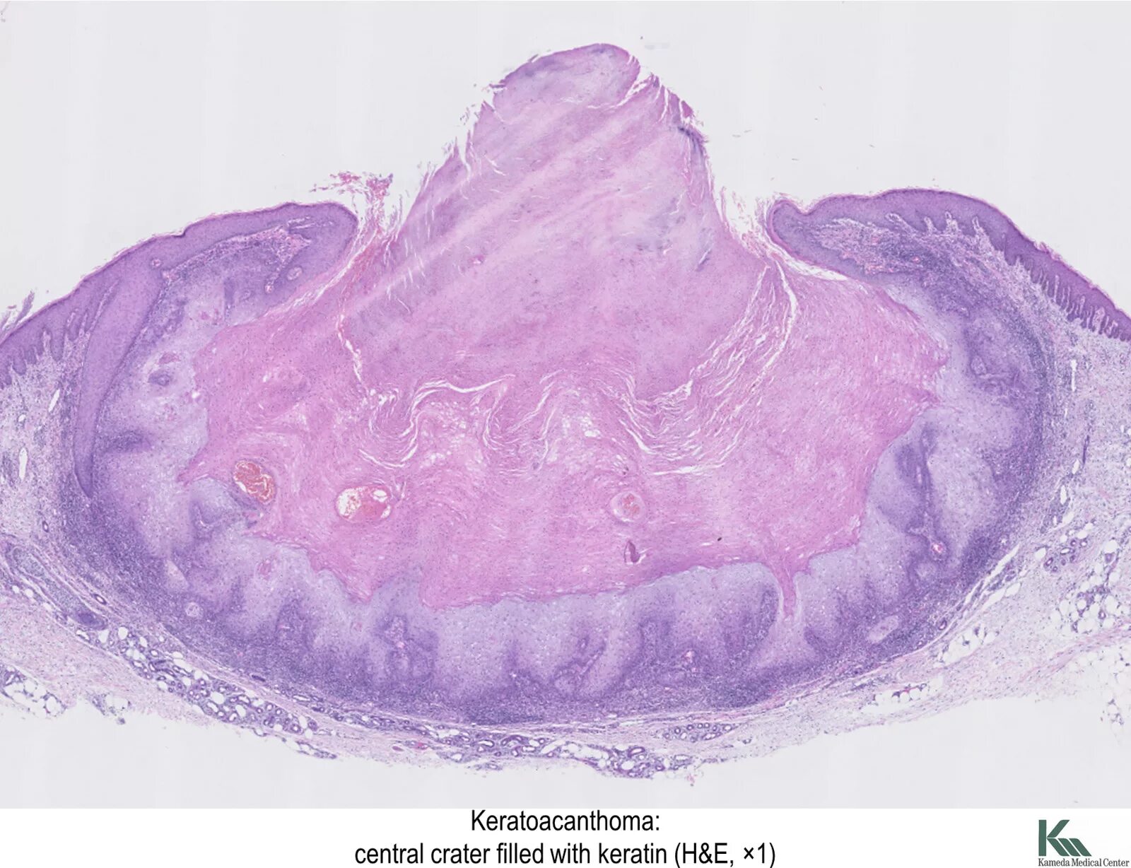 Кератоакантома что это такое фото Regressing Keratoacanthoma Pathology