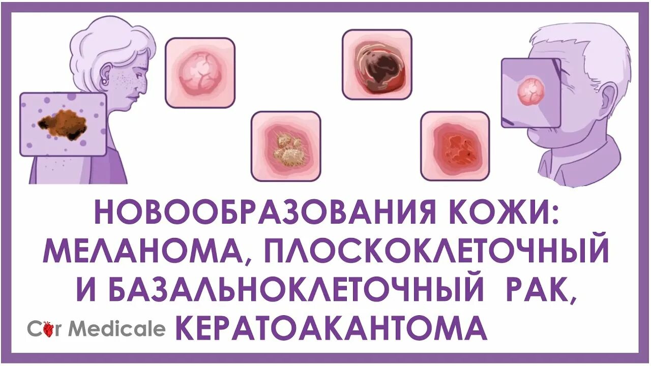 Кератоакантома что это такое фото Новообразования кожи обзорно: меланома, плоскоклеточный и базальноклеточный рак,