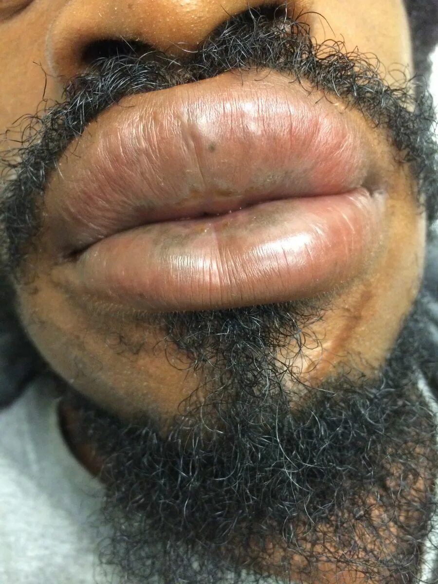 Кератоакантома что это такое фото Index of /w/images/thumb/Angioedema_post_lisinopril_use_2014-12-08_12-35.jpg