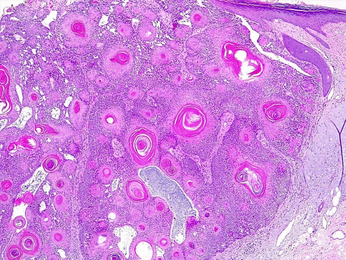 Кератоакантома что это такое фото nyögi th Előrelátás inverted follicular keratosis histology alsószoknya véletlen