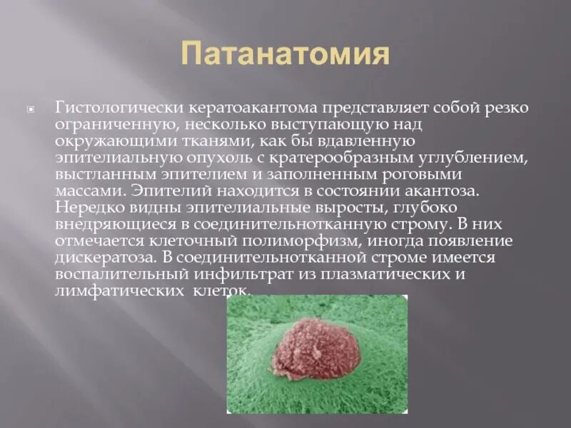 Кератоакантома что это такое фото Кератоакантома
